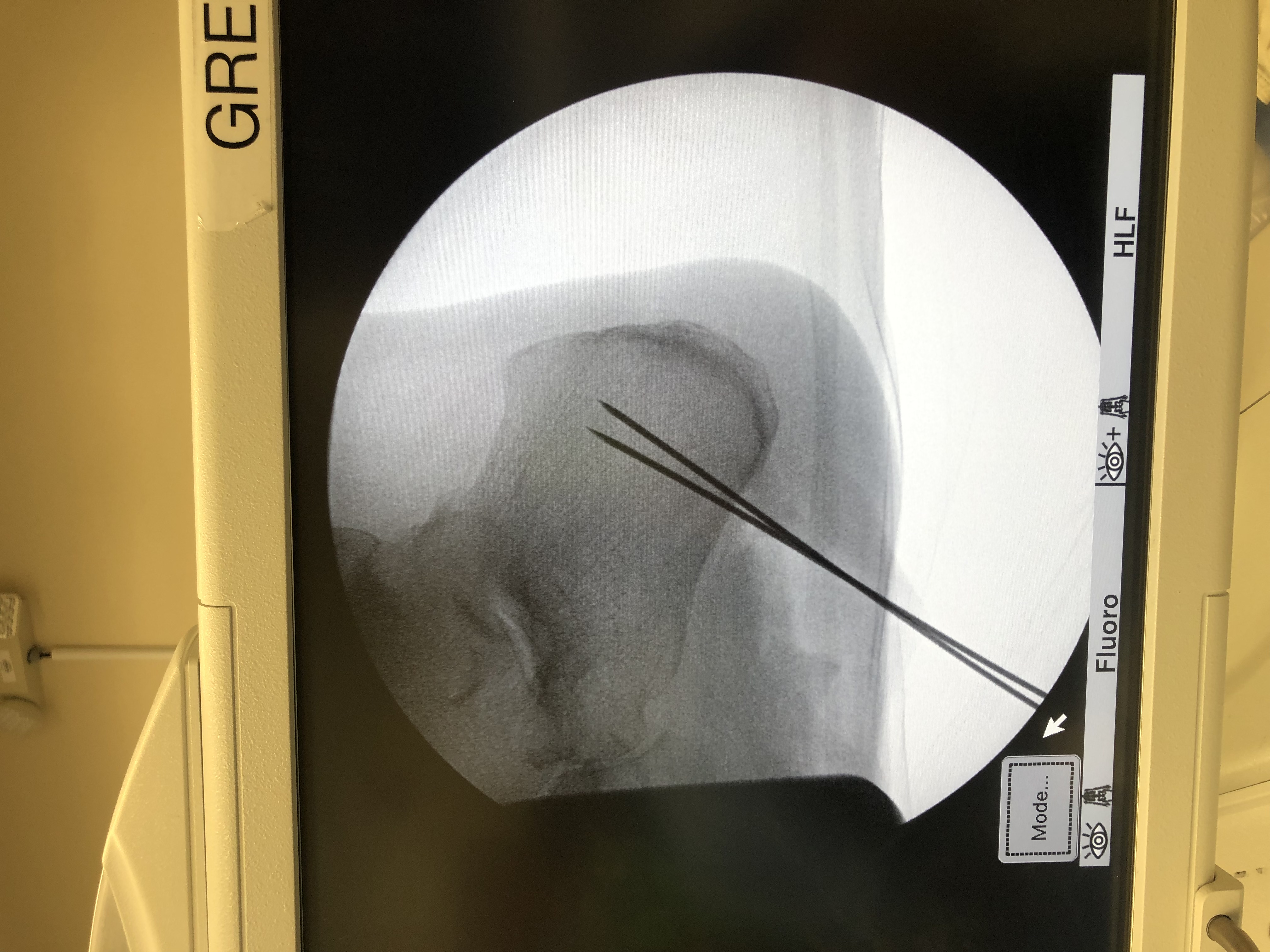 Figure 3. This degenerated segment was resected, and the authors drilled 2 holes were drilled into the calcaneus for placement of bone anchors, and confirmed via radiographic evaluation.