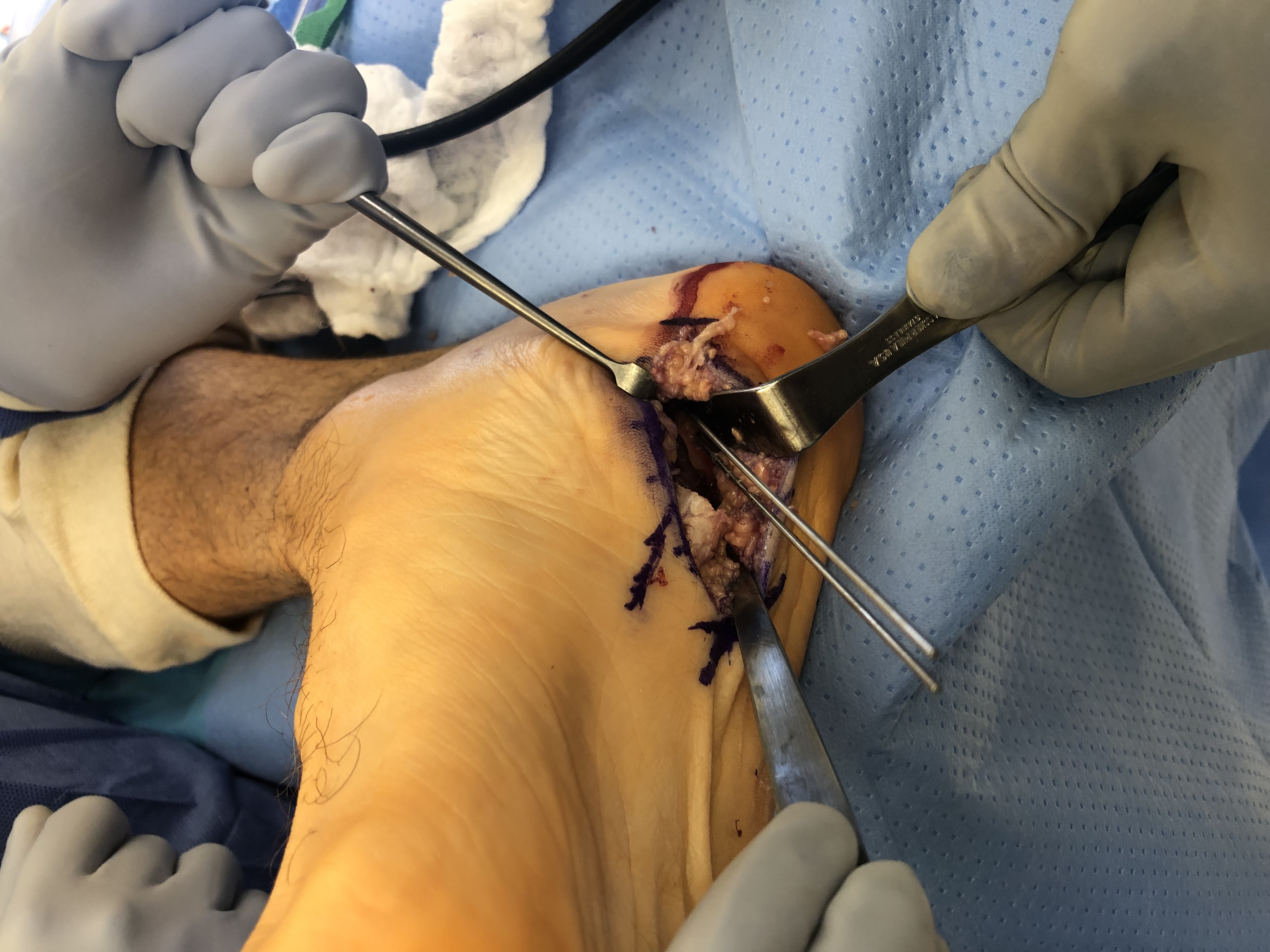 Figure 4. This degenerated segment was resected, and the authors drilled 2 holes were drilled into the calcaneus for placement of bone anchors, and confirmed via radiographic evaluation.