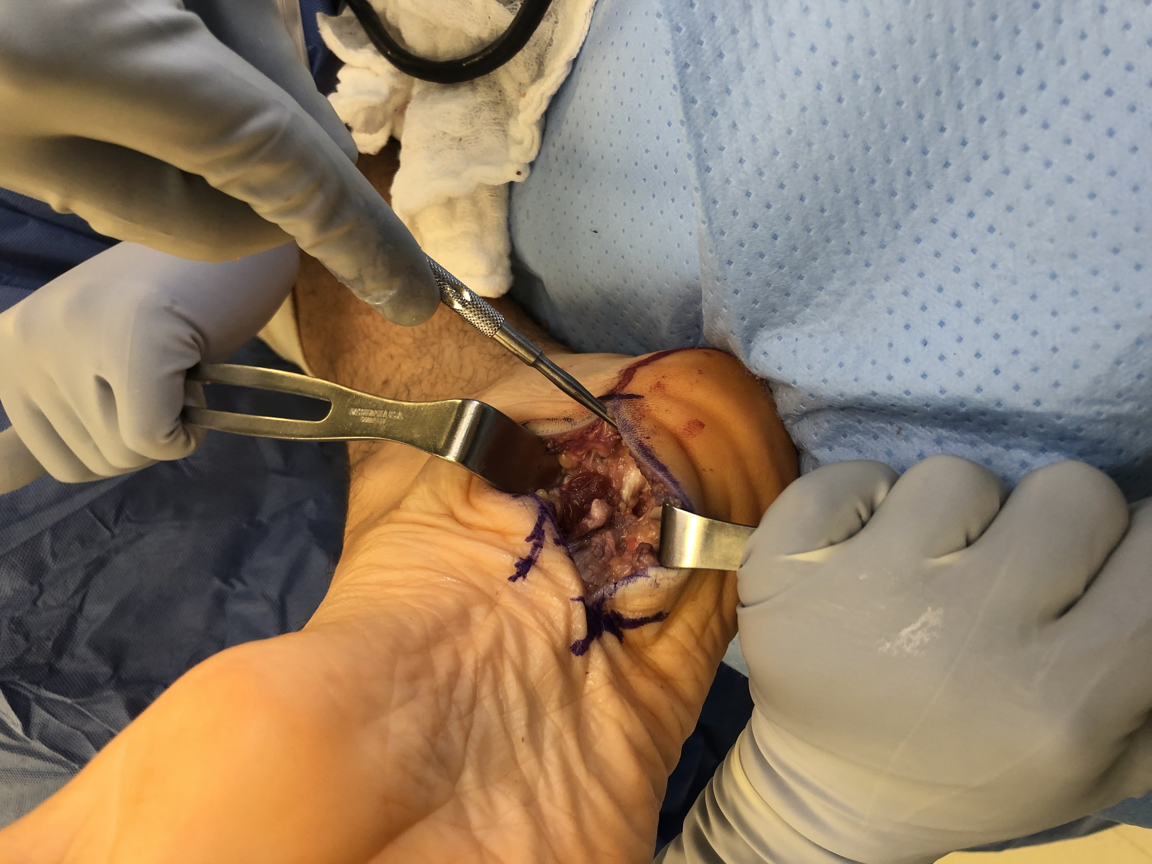 Figure 5. The authors anchored the 0.5 mm graft and wove it through the plantar fascia using a Pulvertaft technique, securing it under physiological tension.