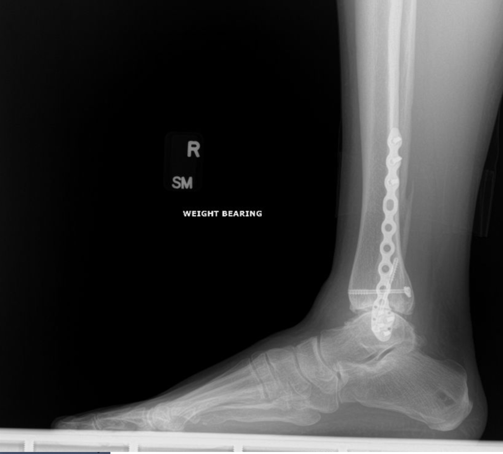 Figure 2. Preoperative radiograph