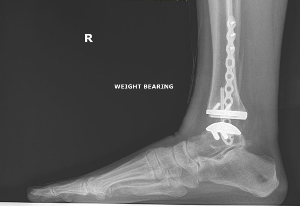 Figure 6. Six months postoperative radiograph
