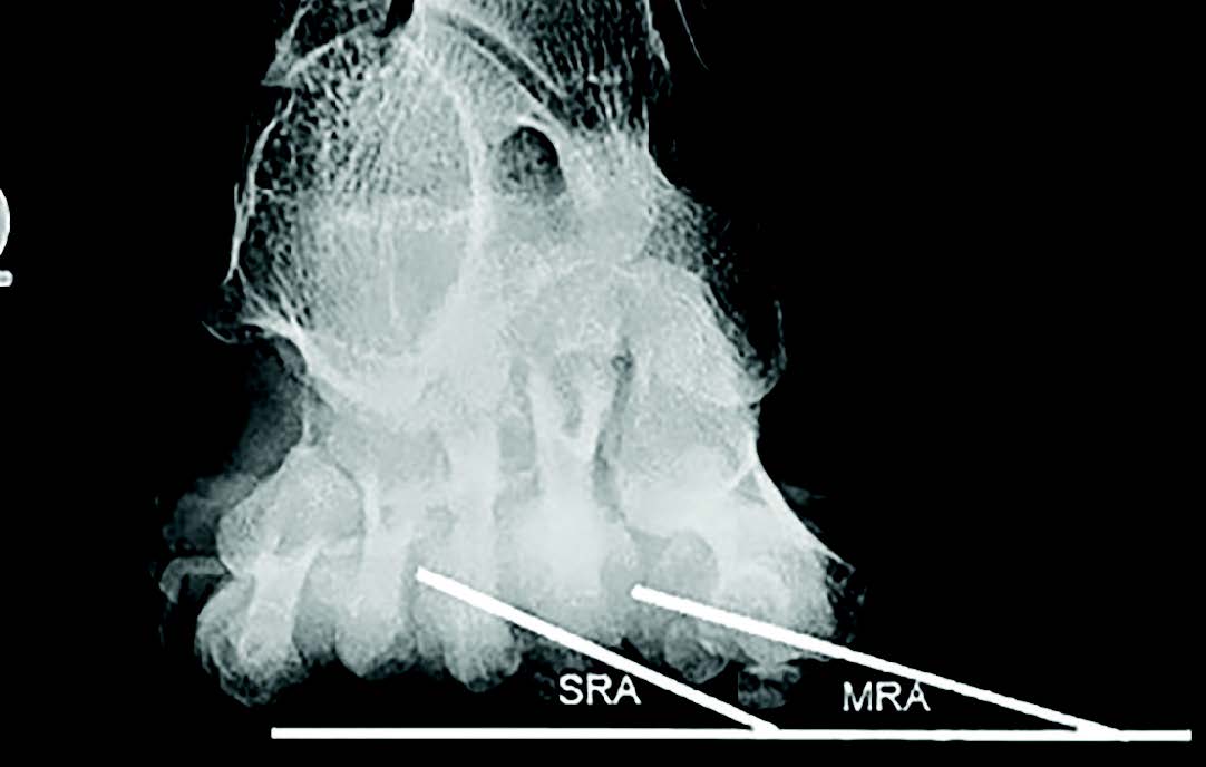 The sesamoid rotation angle (SRA) differs in magnitude from the metatarsal pronation angle (MPA), as seen in this radiographic image.