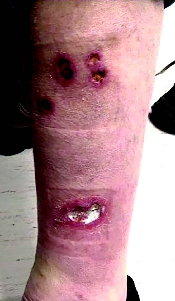 Here one can see jagged ulcerations with violaceous borders and undermined wound edges on the left lower extremity noted on presentation. 