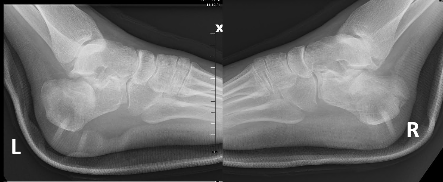 Figure 1. Bilateral lateral preoperative plain film radiographic views demonstrating decreased Böhler’s angle and increased Gissane’s angle, with posterior tuberosity displacement on the right.
