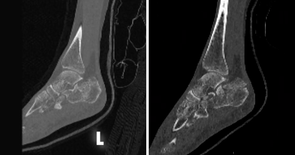 Figure 2. Preoperative CT imaging. A. Left calcaneus demonstrating joint depression pattern with posterior facet involvement. B. Right calcaneus demonstrating tongue-type fracture with posterior tuberosity displacement.