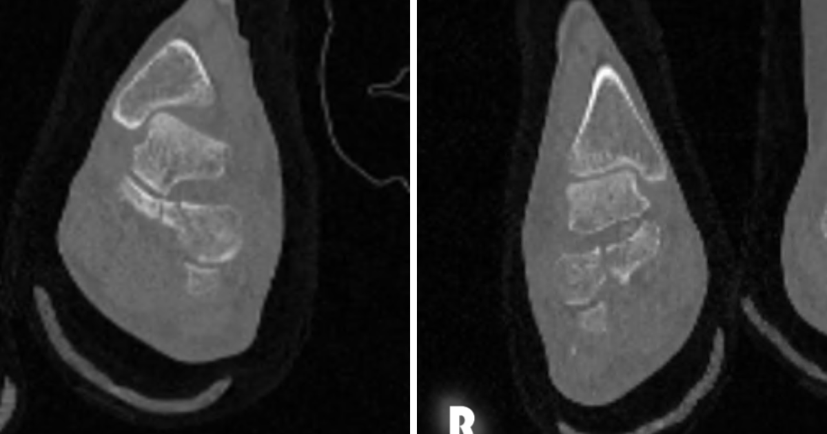 Figure 3 A and B. Here one can see bilateral coronal CT views.