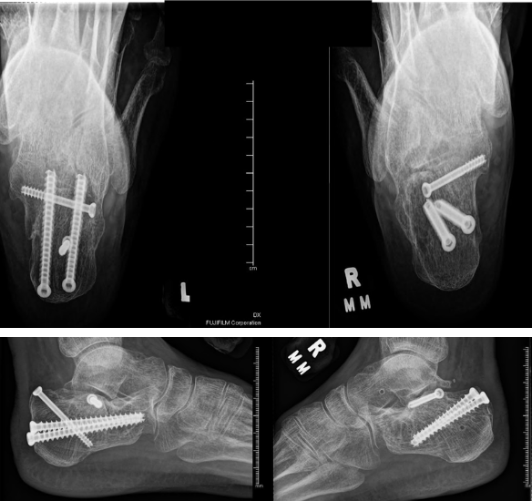Figure 4.Postoperative radiographs. A. Bilateral axial views demonstrating restoration of calcaneal width. B. Bilateral lateral views demonstrating restoration of Böhler’s and Gissane’s angles with improved alignment.