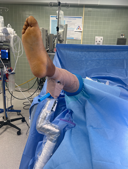 Figure 5. Here one can see the operative extremity secured in a limb positioner, allowing dynamic repositioning and unobstructed fluoroscopic access.