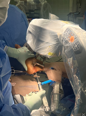 Figure 6. Ligamentotaxis and varus correction using dual distraction. One can see application of a pin-based distractor across the talus and calcaneus with medial distraction and lateral compression to restore length and correct varus alignment.
