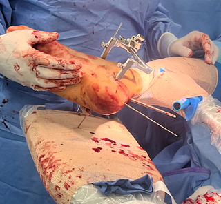 Figure 7. Tuberosity joystick for reduction. Here, a threaded Steinmann pin placed in the posterior calcaneal tuberosity was used as a joystick to restore sagittal alignment.