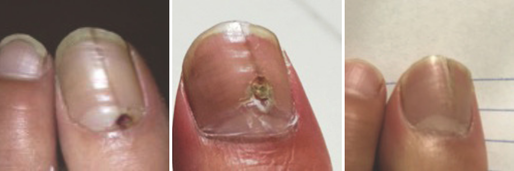 Figures 4–6. The photo on the left shows a procedure site one week after a 3-mm punch biopsy of a longitudinal melanonychia originating in visible distal matrix. This lesion was benign. Note that three months post-biopsy, there is new normal nail plate forming behind the biopsy site as one can see in the middle photo. Lastly, the photo on the right shows the same patient 12 months post-biopsy with complete restoration of normal lunula and nail plate. 
