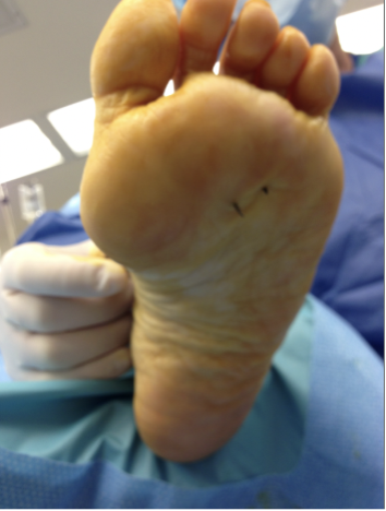 Figure 1. Eighteen-gauge hypodermic needles inserted from dorsal to plantar just proximal to the metatarsal heads identified the precise location of the interspaces and the proximal convergence of the metatarsals.