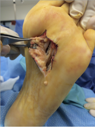 Figure 2. A similar incision and exposure took place for the third interspace.