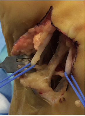 Figure 3. We identified both nerves as adherent to the plantar capsule of the third metatarsal head. We then transected the proximal nerve stumps within the inferior margin of the plantar incision.