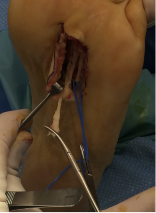 Figure 4. Closure of the epineurium was with 6-0 nylon, allowing the cut nerves to retract proximally into the midfoot .
