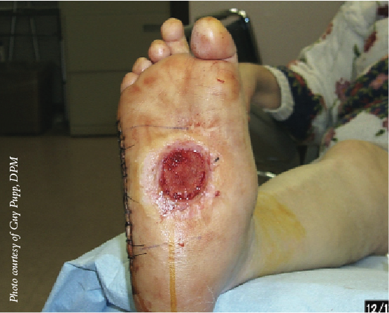 Many wound care patients are of advanced age and have multiple comorbid systemic conditions such as diabetes and PAD, which can contribute to complexity of care.