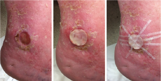 Leukocyte-and platelet-rich fibrin (L-PRF) is an autologous platelet concentrate that includes leukocytes and a higher fibrin density. The multi-layered L-PRF disc is fabricated at bedside using 18mL of the patient’s venous blood.