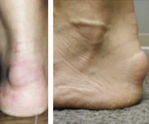 Figure 1. Clinical pictures of retrocalcaneal exostoses. The left picture shows a more superior placement suggestive of a Haglund’s deformity while the right picture shows a more plantar placement, suggesting exostosis involving the Achilles tendon insertion.