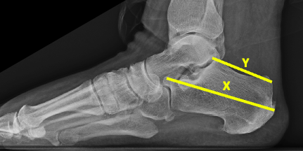 Figure 2. Lateral foot radiograph showing the landmarks to determine the X/Y ratio. The Zadek osteotomy requires a X/Y ratio of less than 2.5 as shown by radiographic studies.4