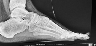 Figure 3. Lateral foot radiograph demonstrating Haglund's retrocalcaneal exostosis and insertional Achilles calcaneal spur. 