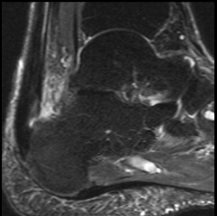 Figure 4. Magnetic resonance imaging (T2-weighted) demonstrates a thickened Achilles tendon with surrounding hyperintensity and signal enhancement at the insertion on the posterior calcaneus and extending 4cm proximally.