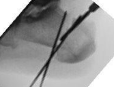 Figure 5. Intraoperative fluoroscopy demonstrating wire placement to set the boundaries of the osteotomy. The width of the wedge resection should be calculated preoperatively. &nbsp;