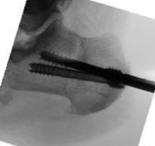 Figure 6.&nbsp; Plantar hinge was preserved while feathering the osteotomy site with posterior pressure. Intraoperative fluoroscopy demonstrates final fixation of calcaneal dorsal closing wedge osteotomy with two headless partially threaded screws.