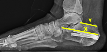 Figure 7. Postoperative radiographs following Zadek osteotomy. The X/Y ratio changed from 2.11 preoperatively to 2.77 postoperatively.
