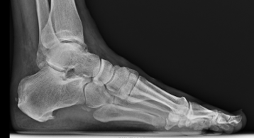 Figure 8.&nbsp; Preoperative radiograph of patient with a 3-year history of retrocalcaneal pain. MRI can be referenced in Figure 4 that shows significant thickening and pathology to the distal Achilles tendon.