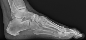 Figure 9. Postoperative radiograph of patient from Figure 8 after undergoing posterior calcaneoplasty with distal Achilles tendon debridement/repair with suture anchors. Successful Haglund’s and retrocalcaneal exostectomies took place with a percutaneous minimally invasive technique. The suture anchors secure the distal Achilles tendon against the posterior calcaneus where the Haglund’s prominence was resected.