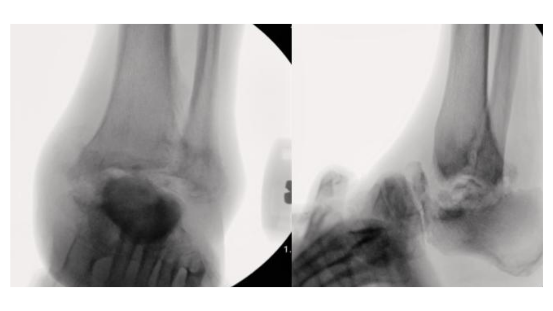 Figure 1. These preoperative radiographs show extensive dated destructive changes noted involving the ankle. Distal tibia and fibula demonstrate destructive erosion. Severe destructive changes of the talus and calcaneus are present. 