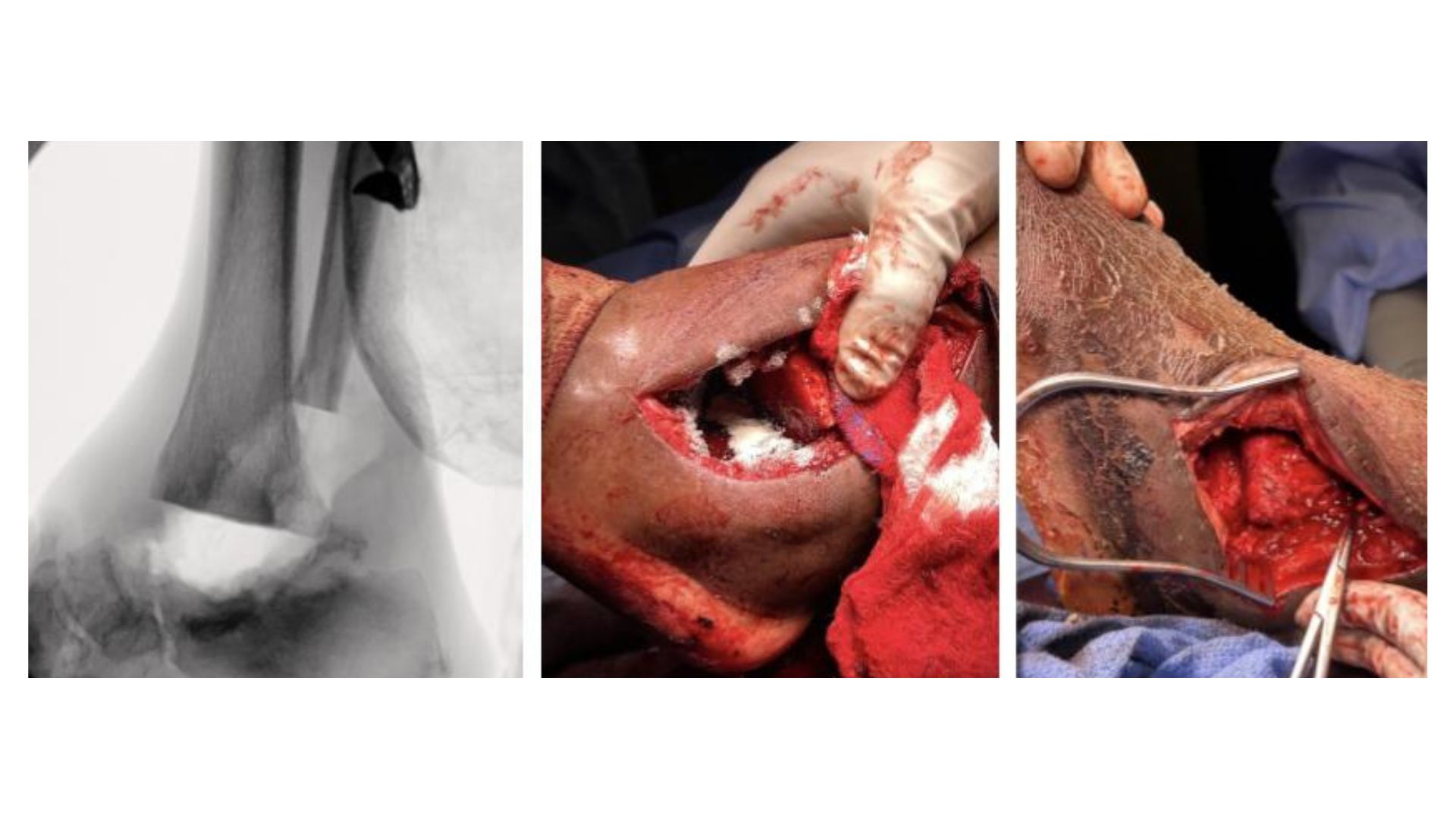 Figure 2. These images show resection of the tibia and osteotomy of the fibula used as a spacer. 