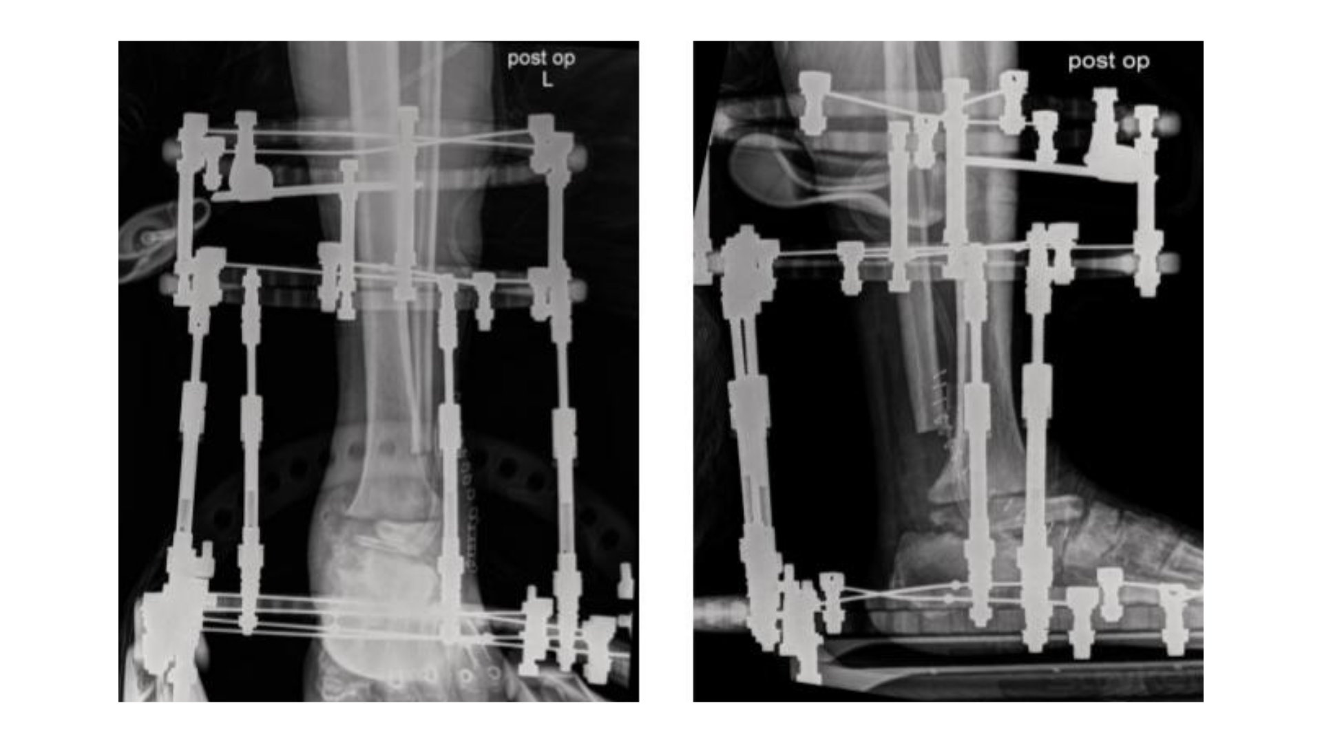 Figure 3. Post-op imaging of external fixation application (May 2025). 