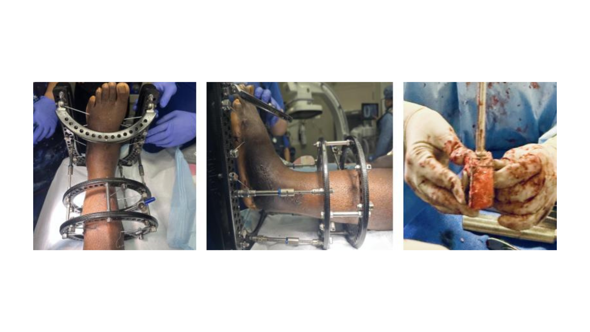 Figure 4. Arthrodesis with 3D Implant (July 2025). After removing the external fixator applied in May, surgeons undertook a definitive reconstruction. Surgeons removed the previous fibula autograft spacer and morselized it to use as graft material within the 3D cage implant.