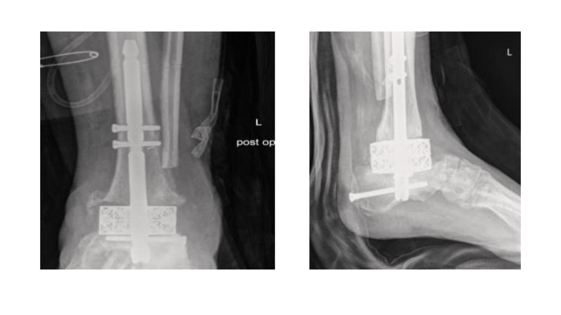 Figure 5. These images show the foot status-post left tibiotalar joint resection with hindfoot prosthesis 3D Arthrocube implant. The long intramedullary rod screw construct extends from the distal tibial shaft to the hindfoot. Hardware is intact.  