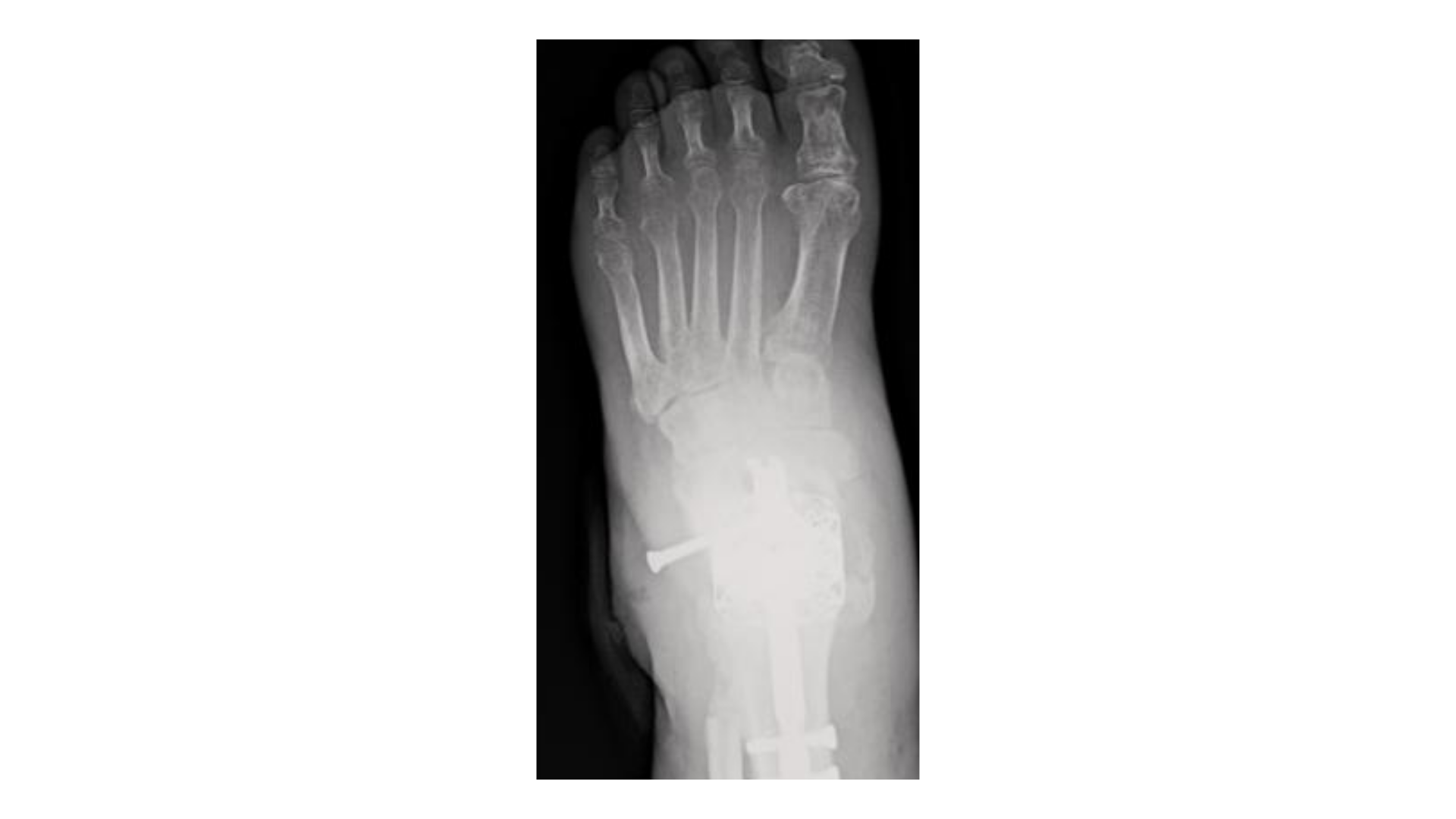 Figure 6. Here is a four-month post-op image showing screw loosening in the calcaneus. 