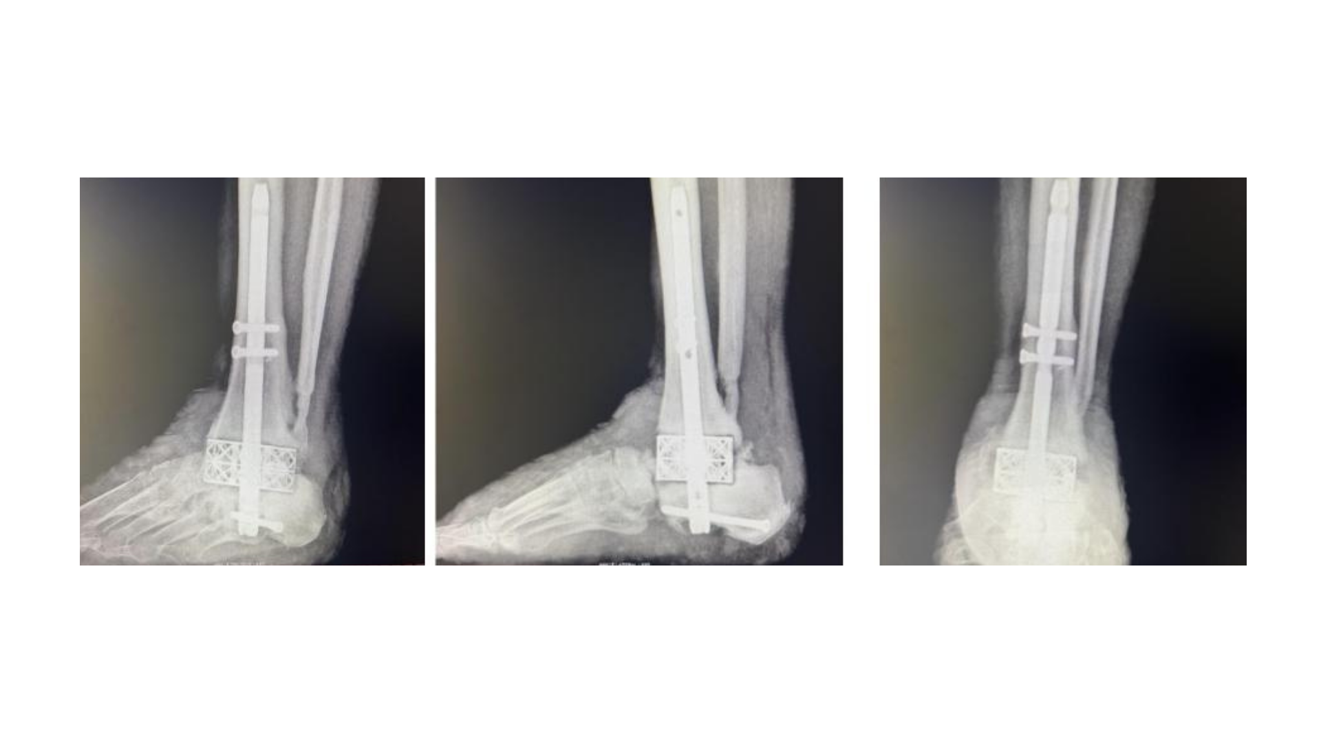 Figure 7. Here are three-view ankle X-ray images taken nine months' post-op fusion with the spacer showing intact and an aligned nail construct with bridging bone on the distal fibula.  