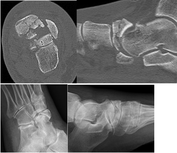 Figure 1. These computed tomography and plain radiographic images show comminuted and displaced intra-articular fracture of the navicular. 