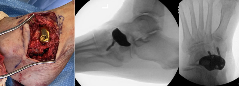Figure 2. These intraoperative images show the navicular implant secured in place.