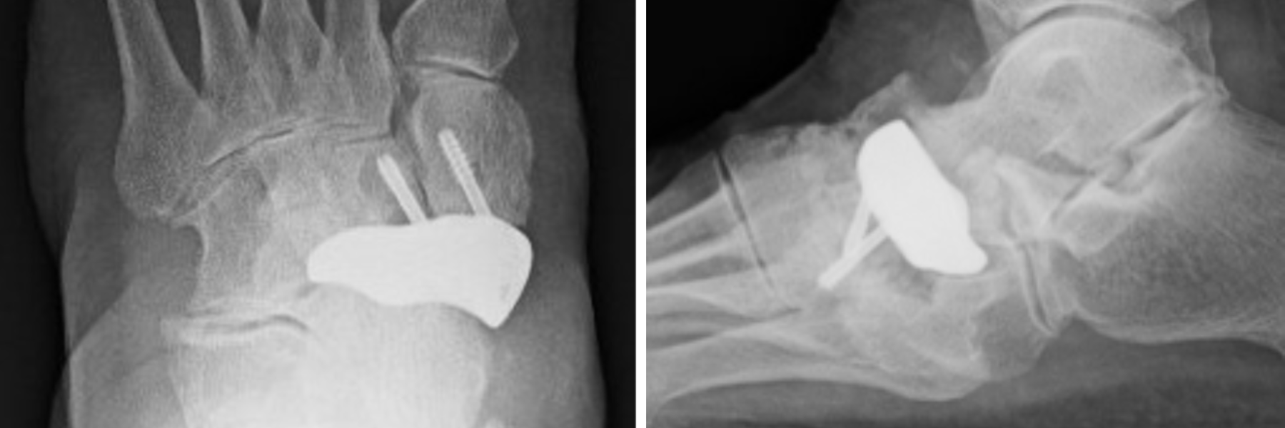 Figure 3. Postoperative radiographs at 12 months show appropriate alignment of the implant.