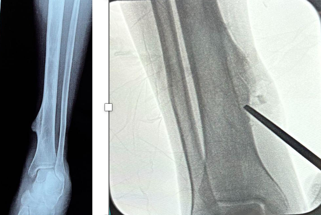 Figure 1. Radiographic images, preoperative (left) and intraoperative (right) of osseous tibial lesion. Note, the intraoperative image appears inverted due to limitations of the available imaging. 