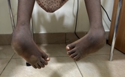 Figure 2. Adolescent with bilateral severely neglected clubfoot deformity  