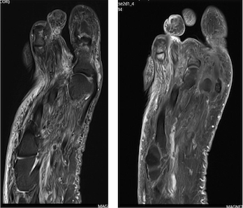 Figure 4. MRI post–incision and drainage. 