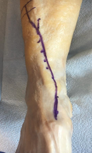 Figure 1. Anteromedial ankle incisional approach 