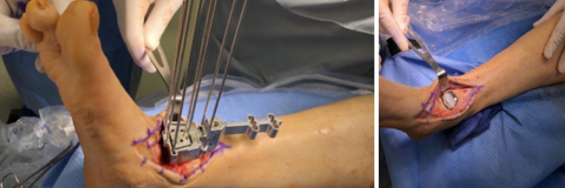 Figure 2. Anteromedial ankle exposure with jig placement (left). Anteromedial ankle exposure with implant in place (right) 
