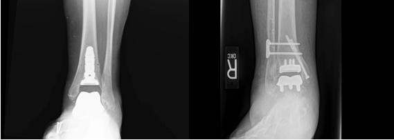 Figure 3. Post-operative weightbearing X-rays. 