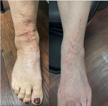 Figure 4. Healed anteromedial incision