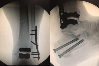 Figure 5. Lateral transfibular approach 