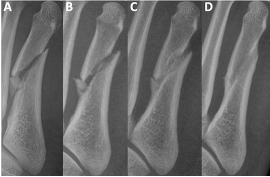 Figure 2. Oblique radiographs of the right foot 5th metatarsal. A: 1 day post-injury. B: 1 month. C: 4 months. D: 11 months.