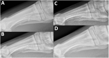 Figure 3. Lateral radiographs of the right foot 5th metatarsal. A: 1 day post-injury. B: 1 month. C: 4 months. D: 11 months.